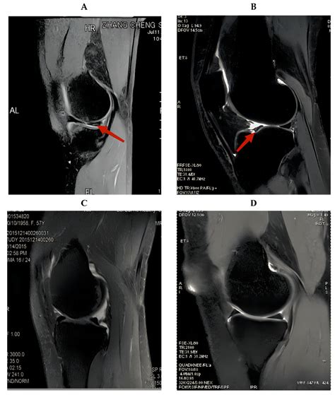 7 test for meniscus tear|diagnose meniscus tear without mri.